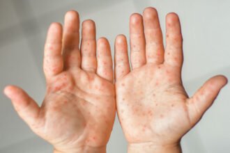 Kleine rote Punkte auf der Haut - Ursachen, Symptome, Behandlung Haben Sie plötzlich kleine rote Punkte auf der Haut bemerkt? Solche Irritationen lösen oft Verunsicherung aus. Aber in vielen Fällen sind sie völlig unbedenklich. Deshalb ist es wichtig, die Veränderungen genau zu beobachten. Ein Hautausschlag mit roten Punkten kann viele Ursachen haben. Es reicht von einfachen Reizungen bis zu allergischen Reaktionen. Jede Veränderung verrät viel über Ihre Gesundheit. In diesem Ratgeber gehen wir auf die häufigsten Ursachen ein. Wir erklären, was Sie beobachten sollten. So wissen Sie, worauf Sie bei Ihrem Körper achten müssen. Die richtige Behandlung hängt von einer genauen Diagnose ab. Manche Flecken verschwinden von selbst. Andere brauchen spezielle Cremes oder medizinische Hilfe. Unser Ziel ist es, Ihnen Sicherheit zu geben. Wir sagen, wann Sie einen Experten aufsuchen sollten. Gute Informationen helfen bei einer schnellen Genesung. Entdecken Sie Tipps für eine gesunde Haut. Wir zeigen, wie Sie Reizungen vermeiden können. Bleiben Sie informiert und schützen Sie Ihre Haut langfristig. Was sind kleine rote Punkte auf der Haut? Kleine rote Punkte auf der Haut können viele Ursachen haben. Sie reichen von harmlosen bis zu ernsthaften Krankheiten. Diese Punkte können in verschiedenen Formen und mit unterschiedlichen Symptomen auftreten. Typische Erscheinungsformen der roten Punkte Man sieht oft stecknadelkopf- bis erbsengroße, hell- bis dunkelrote Punkte. Diese Punkte können allein oder in Gruppen erscheinen. Rubinflecken sind harmlose Hauterscheinungen, die mit dem Alter zunehmen. Sie zeigen, wie rote Punkte auf der Haut aussehen können. Unterschied zwischen Punkten, Flecken und Ausschlag Es ist wichtig, die Unterschiede zwischen Punkten, Flecken und Ausschlag zu kennen. Jeder Begriff beschreibt eine andere Hauterscheinung. Punkte sind in der Regel klein und umschrieben. Flecken können größere Flächen einnehmen. Ein Ausschlag beschreibt eine flächige Hautveränderung, die oft mit Rötung und anderen Symptomen einhergeht. Kleine rote Punkte auf der Haut - Ursachen Kleine rote Punkte auf der Haut können viele Ursachen haben. Manche sind harmlos, andere ernst. Es ist wichtig, die Ursachen zu kennen, um richtig zu behandeln. Petechien - Kleine Blutungen unter der Haut Petechien sind kleine Blutungen unter der Haut. Sie können durch Blutgerinnungsstörungen, Infektionen oder Verletzungen entstehen. Sie sehen aus wie rote oder violette Punkte und können auf Probleme hinweisen. Kirschangiome und Blutschwämmchen Kirschangiome sind gutartige Tumore, die als rote Punkte erscheinen. Sie sind meist harmlos und treten bei Erwachsenen auf. Blutschwämmchen entstehen durch Blutgefäße und sehen ähnlich aus. Allergische Reaktionen und Kontaktdermatitis Allergische Reaktionen auf Substanzen oder Materialien können rote Punkte verursachen. Kontaktdermatitis ist eine Entzündung durch allergene oder irritierende Stoffe. Virale und bakterielle Infektionen Viren und Bakterien können rote Punkte auf der Haut verursachen. Viren wie Masern und Röteln, Bakterien wie Scharlach führen zu Hauterscheinungen. Masern und Röteln bei Kindern Masern und Röteln sind virale Infektionen bei Kindern. Sie führen zu roten Punkten oder Hautausschlag. Sie sind meist selbstlimitierend, können aber Komplikationen haben. Scharlach Scharlach wird durch Streptokokken der Gruppe A verursacht. Es zeigt sich oft durch einen Hautausschlag mit roten Punkten oder Flecken. Windpocken und Gürtelrose Windpocken sind eine virale Infektion durch Varizella-Zoster-Virus. Sie führen zu Hautausschlag mit roten Punkten oder Bläschen. Gürtelrose ist eine Reaktivierung, die schmerzhaft sein kann. Weitere mögliche Ursachen Es gibt noch mehr Ursachen für kleine rote Punkte. Dazu gehören Hitzepickel, Insektenstiche und Hautreizungen. Hitzepickel und Wärmestau Hitzepickel entstehen durch Überhitzung der Haut. Sie treten in heißen und feuchten Umgebungen auf. Insektenstiche und Hautreizungen Insektenstiche können rote Punkte oder Schwellungen verursachen. Auch Hautreizungen durch Substanzen oder Materialien führen zu roten Punkten. Symptome und Begleitsymptome bei roten Punkten Rote Punkte auf der Haut können mit anderen Symptomen einhergehen. Diese können von Juckreiz und Schmerzen bis hin zu keinerlei Beschwerden reichen. Es ist wichtig, diese Symptome zu beachten, um die Ursache der roten Punkte genau zu bestimmen und eine angemessene Behandlung zu erhalten. Rote Punkte mit Juckreiz - Ursachen und Bedeutung Juckreiz ist ein häufiges Begleitsymptom von roten Punkten auf der Haut. Dieser Juckreiz kann auf verschiedene Ursachen hindeuten, wie allergische Reaktionen oder Hauterkrankungen. Wenn rote Punkte jucken, kann dies ein Zeichen für eine Kontaktdermatitis oder eine andere Hautirritation sein. Es ist ratsam, die betroffene Stelle nicht zu kratzen, um weitere Irritationen oder Infektionen zu vermeiden. Stattdessen sollten betroffene Personen einen Arzt aufsuchen, um die genaue Ursache des Juckreizes und der roten Punkte zu ermitteln. Schmerzhafte oder brennende rote Punkte In einigen Fällen können rote Punkte auf der Haut schmerzhaft oder brennend sein. Dies kann auf eine Entzündung oder Infektion der Haut hinweisen. Solche Symptome sollten ernst genommen werden, da sie auf eine zugrunde liegende Erkrankung hinweisen können, die behandelt werden muss. Entzündliche Hauterkrankungen Infektionen durch Bakterien oder Viren Allergische Reaktionen Asymptomatische rote Punkte auf der Haut Es ist auch möglich, dass rote Punkte auf der Haut keine Symptome wie Juckreiz oder Schmerzen verursachen. Asymptomatische rote Punkte können dennoch ein Zeichen für eine zugrunde liegende Erkrankung sein und sollten daher nicht ignoriert werden. Regelmäßige Hautuntersuchungen durch einen Dermatologen können helfen, Veränderungen frühzeitig zu erkennen und entsprechend zu handeln. Warnsignale - Wann sind rote Punkte gefährlich? Bestimmte Symptome in Verbindung mit roten Punkten auf der Haut können auf eine ernsthafte Erkrankung hinweisen. Dazu gehören: Plötzliches Auftreten einer großen Anzahl roter Punkte Schmerzen oder Brennen in Verbindung mit den roten Punkten Fieber oder andere systemische Symptome Wenn solche Warnsignale auftreten, ist es wichtig, umgehend einen Arzt aufzusuchen, um die Ursache abklären zu lassen und eine angemessene Behandlung zu erhalten. Diagnose roter Punkte am Körper Um die Ursache von roten Punkten auf der Haut zu finden, ist eine genaue Untersuchung wichtig. Ein Dermatologe muss die Punkte genau untersuchen. Die dermatologische Untersuchung Die Untersuchung beginnt mit einer gründlichen Inspektion der Haut. Der Dermatologe betrachtet die roten Punkte genau. Er sucht auch nach anderen Symptomen, die auf die Ursache hinweisen könnten. Visuelle Inspektion der Haut Überprüfung der medizinischen Geschichte Untersuchung auf andere Symptome Erforderliche medizinische Tests und Blutuntersuchungen Nach der Untersuchung können weitere Tests nötig sein. Blutuntersuchungen helfen, Infektionen oder andere Erkrankungen zu finden. Bluttests zum Nachweis von Infektionen Allergietests, um allergische Reaktionen auszuschließen Weitere Tests, um die genaue Ursache zu bestimmen Besonderheiten bei der Diagnose von roten Punkten bei Kindern und Erwachsenen Bei Kindern und Erwachsenen kann die Diagnose unterschiedlich sein. Rote Punkte bei Kindern sind oft harmlos und können durch Viren verursacht werden. Bei Erwachsenen können rote Punkte ein Zeichen für eine ernstere Krankheit sein. Behandlung von roten Punkten auf der Haut Die Behandlung von roten Punkten hängt von der Ursache ab. Eine genaue Diagnose ist wichtig, um die richtige Behandlung zu finden. Medikamentöse Therapieoptionen Es gibt verschiedene medikamentöse Wege, um Symptome zu lindern. Diese Wege zielen darauf ab, die Ursache zu behandeln. Antihistaminika bei allergischem Hautausschlag Antihistaminika helfen bei allergischen Reaktionen. Sie lindern Juckreiz und hemmen die allergische Reaktion. Kortison-Cremes und entzündungshemmende Salben Kortison-Cremes und entzündungshemmende Salben wirken bei entzündlichen Hautreaktionen. Sie reduzieren Rötung und Juckreiz. Antibiotika bei bakteriellen Infektionen Bei bakteriellen Infektionen sind Antibiotika nötig. Sie bekämpfen die Infektion. Bewährte Hausmittel gegen rote Punkte Es gibt Hausmittel, die Symptome lindern können. Dazu gehören: Aloe Vera zur Beruhigung der Haut Kühlende Umschläge, um Juckreiz und Rötung zu reduzieren Ölbäder, um die Haut zu pflegen und zu beruhigen Professionelle Entfernung von Kirschangiomen Manchmal ist eine professionelle Entfernung von Kirschangiomen nötig. Das gilt besonders bei kosmetischen Problemen oder Unsicherheit über ihre Natur. Wann ist ein Arztbesuch unbedingt erforderlich? Ein Arztbesuch ist wichtig bei bestimmten Symptomen. Dazu gehören Fieber, Schmerzen oder Atemnot. Auch wenn die roten Punkte sich verändern oder nicht auf Behandlung reagieren. Fazit Kleine rote Punkte auf der Haut können viele Gründe haben. Sie zeigen oft unterschiedliche Symptome. Eine genaue Diagnose ist wichtig, um die Ursache zu finden und richtig zu behandeln. Wenn man weiß, was die Punkte bedeuten können, kann man helfen. Petechien, Kirschangiome oder Allergien sind Beispiele dafür. So kann man die Symptome besser bekämpfen. Bei roten Punkten sollte man einen Arzt aufsuchen. Nur so kann man eine genaue Diagnose und Behandlung bekommen. Die Behandlung hängt von der Ursache ab. Es gibt Medikamente und auch spezielle Entfernungsmethoden. Wenn man sich über Ursachen und Behandlungen informiert, kann man am besten handeln. So findet man die beste Lösung für den eigenen Fall. FAQ - Häufige Fragen zu roten Punkten auf der Haut Warum entstehen plötzlich kleine rote Punkte auf der Haut? Plötzliche rote Punkte können viele Ursachen haben. Oft sind es allergische Reaktionen oder kleine Einblutungen. Bei unklaren Punkten ist ein Arztbesuch wichtig. Was ist die Ursache für rote Punkte am Körper ohne Beschwerden? Ohne Beschwerden sind rote Punkte oft harmlos. Sie können Kirschangiome sein, die mit dem Alter entstehen. Sie sind völlig harmlos. Was bedeutet ein Hautausschlag rote Punkte bei Kindern? Bei Kindern sind rote Punkte oft ein Zeichen für Krankheiten wie Windpocken. Eine Untersuchung beim Kinderarzt ist wichtig, um die Krankheit zu bestimmen. Warum verursachen manche rote Punkte Juckreiz? Manche rote Punkte können jucken. Das zeigt oft eine Entzündungsreaktion. Insektenstiche oder Allergien können die Ursache sein. Kühlende Gele oder Antihistaminika können helfen. Gibt es Unterschiede bei rote Punkte Erwachsene im Vergleich zu Kindern? Ja, bei Erwachsenen sind rote Punkte oft die Folge von Medikamenten oder Hautkrankheiten. Bei Kindern sind es meist Infekte oder Allergien. Sind kleine rote Flecken auf der Haut das Gleiche wie Punkte? Nein, nicht immer. Flecken sind oft flach und größer als Punkte. Sie können auf Entzündungen wie Ekzeme hinweisen, während Punkte oft Gefäße betreffen. Wann sind Punkte auf der Haut ein Notfall? Punkte sind ein Notfall, wenn sie nicht wegdrücken lassen oder bei Schmerzen. Auch bei Fieber und Unwohlsein ist sofort ein Arztbesuch nötig.