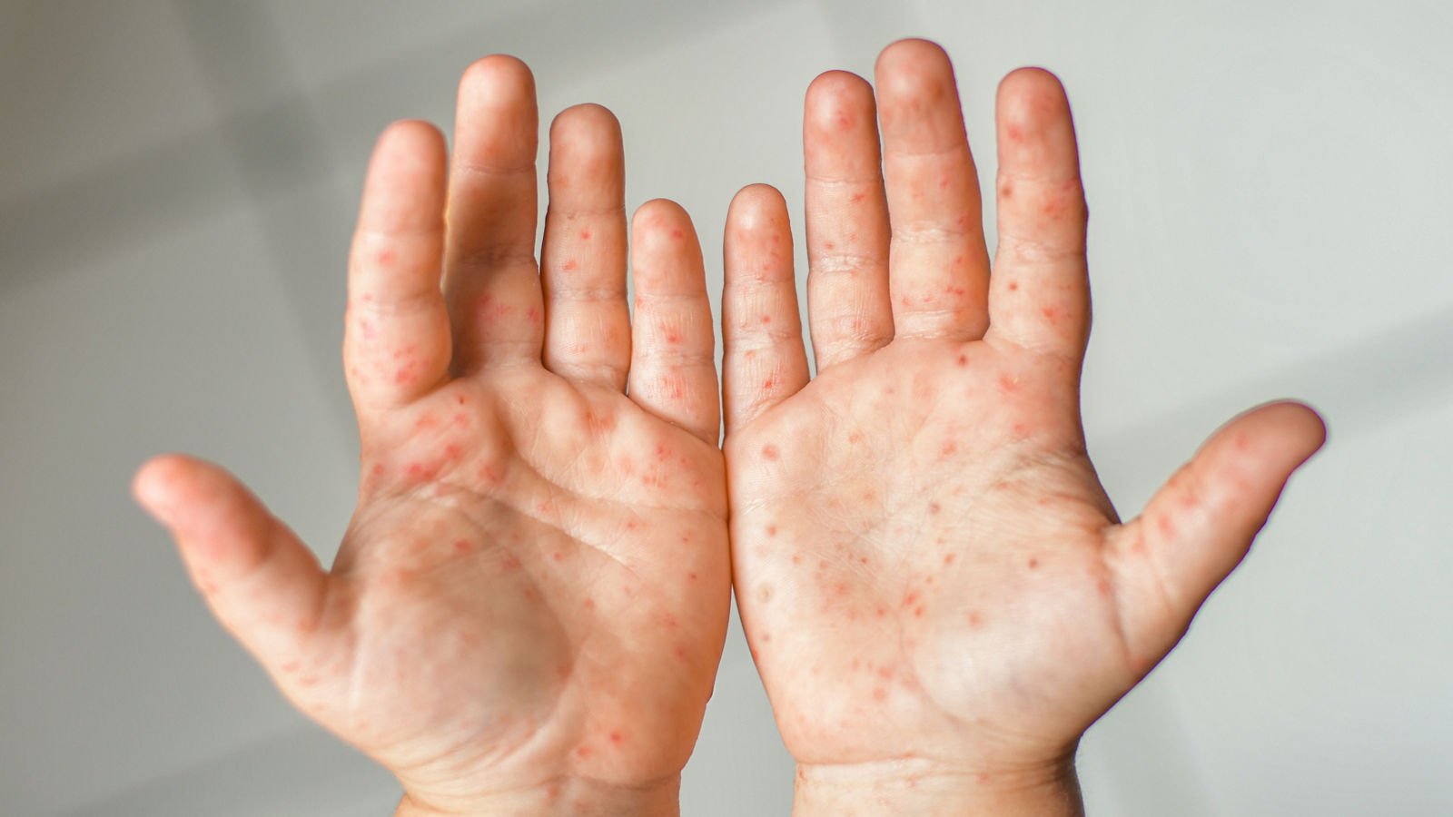 Kleine rote Punkte auf der Haut - Ursachen, Symptome, Behandlung Haben Sie plötzlich kleine rote Punkte auf der Haut bemerkt? Solche Irritationen lösen oft Verunsicherung aus. Aber in vielen Fällen sind sie völlig unbedenklich. Deshalb ist es wichtig, die Veränderungen genau zu beobachten. Ein Hautausschlag mit roten Punkten kann viele Ursachen haben. Es reicht von einfachen Reizungen bis zu allergischen Reaktionen. Jede Veränderung verrät viel über Ihre Gesundheit. In diesem Ratgeber gehen wir auf die häufigsten Ursachen ein. Wir erklären, was Sie beobachten sollten. So wissen Sie, worauf Sie bei Ihrem Körper achten müssen. Die richtige Behandlung hängt von einer genauen Diagnose ab. Manche Flecken verschwinden von selbst. Andere brauchen spezielle Cremes oder medizinische Hilfe. Unser Ziel ist es, Ihnen Sicherheit zu geben. Wir sagen, wann Sie einen Experten aufsuchen sollten. Gute Informationen helfen bei einer schnellen Genesung. Entdecken Sie Tipps für eine gesunde Haut. Wir zeigen, wie Sie Reizungen vermeiden können. Bleiben Sie informiert und schützen Sie Ihre Haut langfristig. Was sind kleine rote Punkte auf der Haut? Kleine rote Punkte auf der Haut können viele Ursachen haben. Sie reichen von harmlosen bis zu ernsthaften Krankheiten. Diese Punkte können in verschiedenen Formen und mit unterschiedlichen Symptomen auftreten. Typische Erscheinungsformen der roten Punkte Man sieht oft stecknadelkopf- bis erbsengroße, hell- bis dunkelrote Punkte. Diese Punkte können allein oder in Gruppen erscheinen. Rubinflecken sind harmlose Hauterscheinungen, die mit dem Alter zunehmen. Sie zeigen, wie rote Punkte auf der Haut aussehen können. Unterschied zwischen Punkten, Flecken und Ausschlag Es ist wichtig, die Unterschiede zwischen Punkten, Flecken und Ausschlag zu kennen. Jeder Begriff beschreibt eine andere Hauterscheinung. Punkte sind in der Regel klein und umschrieben. Flecken können größere Flächen einnehmen. Ein Ausschlag beschreibt eine flächige Hautveränderung, die oft mit Rötung und anderen Symptomen einhergeht. Kleine rote Punkte auf der Haut - Ursachen Kleine rote Punkte auf der Haut können viele Ursachen haben. Manche sind harmlos, andere ernst. Es ist wichtig, die Ursachen zu kennen, um richtig zu behandeln. Petechien - Kleine Blutungen unter der Haut Petechien sind kleine Blutungen unter der Haut. Sie können durch Blutgerinnungsstörungen, Infektionen oder Verletzungen entstehen. Sie sehen aus wie rote oder violette Punkte und können auf Probleme hinweisen. Kirschangiome und Blutschwämmchen Kirschangiome sind gutartige Tumore, die als rote Punkte erscheinen. Sie sind meist harmlos und treten bei Erwachsenen auf. Blutschwämmchen entstehen durch Blutgefäße und sehen ähnlich aus. Allergische Reaktionen und Kontaktdermatitis Allergische Reaktionen auf Substanzen oder Materialien können rote Punkte verursachen. Kontaktdermatitis ist eine Entzündung durch allergene oder irritierende Stoffe. Virale und bakterielle Infektionen Viren und Bakterien können rote Punkte auf der Haut verursachen. Viren wie Masern und Röteln, Bakterien wie Scharlach führen zu Hauterscheinungen. Masern und Röteln bei Kindern Masern und Röteln sind virale Infektionen bei Kindern. Sie führen zu roten Punkten oder Hautausschlag. Sie sind meist selbstlimitierend, können aber Komplikationen haben. Scharlach Scharlach wird durch Streptokokken der Gruppe A verursacht. Es zeigt sich oft durch einen Hautausschlag mit roten Punkten oder Flecken. Windpocken und Gürtelrose Windpocken sind eine virale Infektion durch Varizella-Zoster-Virus. Sie führen zu Hautausschlag mit roten Punkten oder Bläschen. Gürtelrose ist eine Reaktivierung, die schmerzhaft sein kann. Weitere mögliche Ursachen Es gibt noch mehr Ursachen für kleine rote Punkte. Dazu gehören Hitzepickel, Insektenstiche und Hautreizungen. Hitzepickel und Wärmestau Hitzepickel entstehen durch Überhitzung der Haut. Sie treten in heißen und feuchten Umgebungen auf. Insektenstiche und Hautreizungen Insektenstiche können rote Punkte oder Schwellungen verursachen. Auch Hautreizungen durch Substanzen oder Materialien führen zu roten Punkten. Symptome und Begleitsymptome bei roten Punkten Rote Punkte auf der Haut können mit anderen Symptomen einhergehen. Diese können von Juckreiz und Schmerzen bis hin zu keinerlei Beschwerden reichen. Es ist wichtig, diese Symptome zu beachten, um die Ursache der roten Punkte genau zu bestimmen und eine angemessene Behandlung zu erhalten. Rote Punkte mit Juckreiz - Ursachen und Bedeutung Juckreiz ist ein häufiges Begleitsymptom von roten Punkten auf der Haut. Dieser Juckreiz kann auf verschiedene Ursachen hindeuten, wie allergische Reaktionen oder Hauterkrankungen. Wenn rote Punkte jucken, kann dies ein Zeichen für eine Kontaktdermatitis oder eine andere Hautirritation sein. Es ist ratsam, die betroffene Stelle nicht zu kratzen, um weitere Irritationen oder Infektionen zu vermeiden. Stattdessen sollten betroffene Personen einen Arzt aufsuchen, um die genaue Ursache des Juckreizes und der roten Punkte zu ermitteln. Schmerzhafte oder brennende rote Punkte In einigen Fällen können rote Punkte auf der Haut schmerzhaft oder brennend sein. Dies kann auf eine Entzündung oder Infektion der Haut hinweisen. Solche Symptome sollten ernst genommen werden, da sie auf eine zugrunde liegende Erkrankung hinweisen können, die behandelt werden muss. Entzündliche Hauterkrankungen Infektionen durch Bakterien oder Viren Allergische Reaktionen Asymptomatische rote Punkte auf der Haut Es ist auch möglich, dass rote Punkte auf der Haut keine Symptome wie Juckreiz oder Schmerzen verursachen. Asymptomatische rote Punkte können dennoch ein Zeichen für eine zugrunde liegende Erkrankung sein und sollten daher nicht ignoriert werden. Regelmäßige Hautuntersuchungen durch einen Dermatologen können helfen, Veränderungen frühzeitig zu erkennen und entsprechend zu handeln. Warnsignale - Wann sind rote Punkte gefährlich? Bestimmte Symptome in Verbindung mit roten Punkten auf der Haut können auf eine ernsthafte Erkrankung hinweisen. Dazu gehören: Plötzliches Auftreten einer großen Anzahl roter Punkte Schmerzen oder Brennen in Verbindung mit den roten Punkten Fieber oder andere systemische Symptome Wenn solche Warnsignale auftreten, ist es wichtig, umgehend einen Arzt aufzusuchen, um die Ursache abklären zu lassen und eine angemessene Behandlung zu erhalten. Diagnose roter Punkte am Körper Um die Ursache von roten Punkten auf der Haut zu finden, ist eine genaue Untersuchung wichtig. Ein Dermatologe muss die Punkte genau untersuchen. Die dermatologische Untersuchung Die Untersuchung beginnt mit einer gründlichen Inspektion der Haut. Der Dermatologe betrachtet die roten Punkte genau. Er sucht auch nach anderen Symptomen, die auf die Ursache hinweisen könnten. Visuelle Inspektion der Haut Überprüfung der medizinischen Geschichte Untersuchung auf andere Symptome Erforderliche medizinische Tests und Blutuntersuchungen Nach der Untersuchung können weitere Tests nötig sein. Blutuntersuchungen helfen, Infektionen oder andere Erkrankungen zu finden. Bluttests zum Nachweis von Infektionen Allergietests, um allergische Reaktionen auszuschließen Weitere Tests, um die genaue Ursache zu bestimmen Besonderheiten bei der Diagnose von roten Punkten bei Kindern und Erwachsenen Bei Kindern und Erwachsenen kann die Diagnose unterschiedlich sein. Rote Punkte bei Kindern sind oft harmlos und können durch Viren verursacht werden. Bei Erwachsenen können rote Punkte ein Zeichen für eine ernstere Krankheit sein. Behandlung von roten Punkten auf der Haut Die Behandlung von roten Punkten hängt von der Ursache ab. Eine genaue Diagnose ist wichtig, um die richtige Behandlung zu finden. Medikamentöse Therapieoptionen Es gibt verschiedene medikamentöse Wege, um Symptome zu lindern. Diese Wege zielen darauf ab, die Ursache zu behandeln. Antihistaminika bei allergischem Hautausschlag Antihistaminika helfen bei allergischen Reaktionen. Sie lindern Juckreiz und hemmen die allergische Reaktion. Kortison-Cremes und entzündungshemmende Salben Kortison-Cremes und entzündungshemmende Salben wirken bei entzündlichen Hautreaktionen. Sie reduzieren Rötung und Juckreiz. Antibiotika bei bakteriellen Infektionen Bei bakteriellen Infektionen sind Antibiotika nötig. Sie bekämpfen die Infektion. Bewährte Hausmittel gegen rote Punkte Es gibt Hausmittel, die Symptome lindern können. Dazu gehören: Aloe Vera zur Beruhigung der Haut Kühlende Umschläge, um Juckreiz und Rötung zu reduzieren Ölbäder, um die Haut zu pflegen und zu beruhigen Professionelle Entfernung von Kirschangiomen Manchmal ist eine professionelle Entfernung von Kirschangiomen nötig. Das gilt besonders bei kosmetischen Problemen oder Unsicherheit über ihre Natur. Wann ist ein Arztbesuch unbedingt erforderlich? Ein Arztbesuch ist wichtig bei bestimmten Symptomen. Dazu gehören Fieber, Schmerzen oder Atemnot. Auch wenn die roten Punkte sich verändern oder nicht auf Behandlung reagieren. Fazit Kleine rote Punkte auf der Haut können viele Gründe haben. Sie zeigen oft unterschiedliche Symptome. Eine genaue Diagnose ist wichtig, um die Ursache zu finden und richtig zu behandeln. Wenn man weiß, was die Punkte bedeuten können, kann man helfen. Petechien, Kirschangiome oder Allergien sind Beispiele dafür. So kann man die Symptome besser bekämpfen. Bei roten Punkten sollte man einen Arzt aufsuchen. Nur so kann man eine genaue Diagnose und Behandlung bekommen. Die Behandlung hängt von der Ursache ab. Es gibt Medikamente und auch spezielle Entfernungsmethoden. Wenn man sich über Ursachen und Behandlungen informiert, kann man am besten handeln. So findet man die beste Lösung für den eigenen Fall. FAQ - Häufige Fragen zu roten Punkten auf der Haut Warum entstehen plötzlich kleine rote Punkte auf der Haut? Plötzliche rote Punkte können viele Ursachen haben. Oft sind es allergische Reaktionen oder kleine Einblutungen. Bei unklaren Punkten ist ein Arztbesuch wichtig. Was ist die Ursache für rote Punkte am Körper ohne Beschwerden? Ohne Beschwerden sind rote Punkte oft harmlos. Sie können Kirschangiome sein, die mit dem Alter entstehen. Sie sind völlig harmlos. Was bedeutet ein Hautausschlag rote Punkte bei Kindern? Bei Kindern sind rote Punkte oft ein Zeichen für Krankheiten wie Windpocken. Eine Untersuchung beim Kinderarzt ist wichtig, um die Krankheit zu bestimmen. Warum verursachen manche rote Punkte Juckreiz? Manche rote Punkte können jucken. Das zeigt oft eine Entzündungsreaktion. Insektenstiche oder Allergien können die Ursache sein. Kühlende Gele oder Antihistaminika können helfen. Gibt es Unterschiede bei rote Punkte Erwachsene im Vergleich zu Kindern? Ja, bei Erwachsenen sind rote Punkte oft die Folge von Medikamenten oder Hautkrankheiten. Bei Kindern sind es meist Infekte oder Allergien. Sind kleine rote Flecken auf der Haut das Gleiche wie Punkte? Nein, nicht immer. Flecken sind oft flach und größer als Punkte. Sie können auf Entzündungen wie Ekzeme hinweisen, während Punkte oft Gefäße betreffen. Wann sind Punkte auf der Haut ein Notfall? Punkte sind ein Notfall, wenn sie nicht wegdrücken lassen oder bei Schmerzen. Auch bei Fieber und Unwohlsein ist sofort ein Arztbesuch nötig.